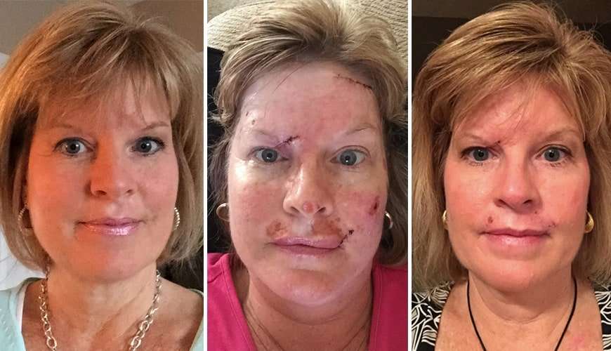 This Woman Shared Raw Photos of Her Skin Cancer Recovery ...