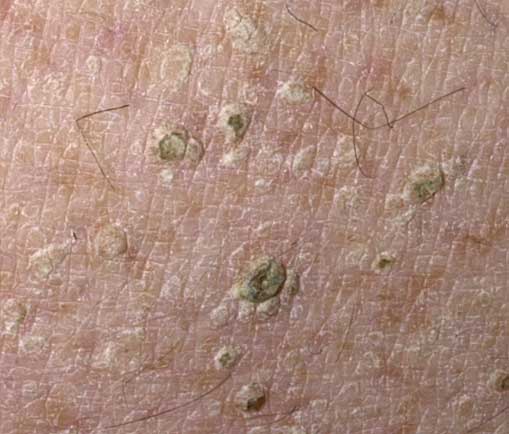 tiny brown spots on skin