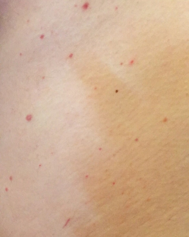 tiny red dots on legs