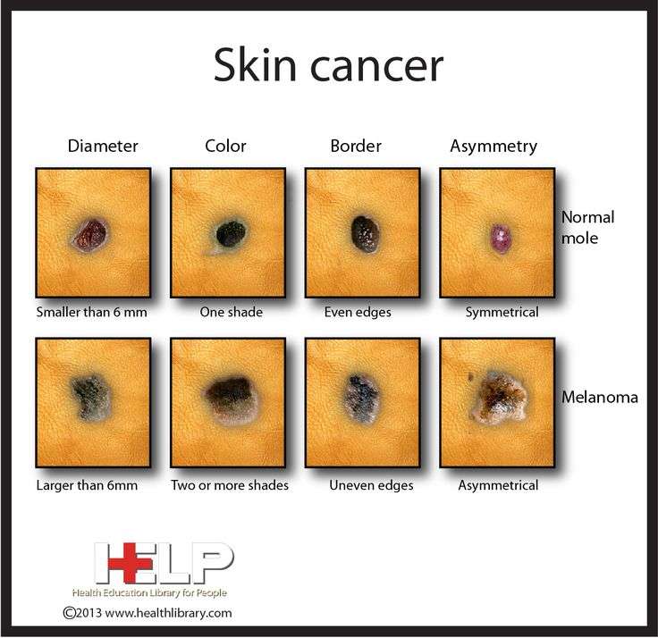 To help you identify skin cancer on your clients