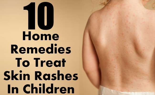 Top 10 Home Remedies To Treat Skin Rashes In Children