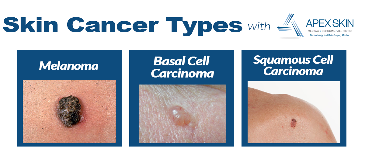Top 10 Risk Factors for Skin Cancer  Apex Dermatology ...