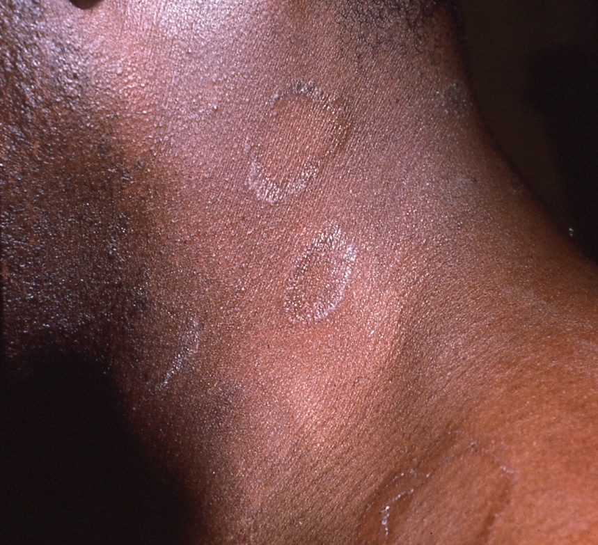 Tottenham: [Download 22+] Eczema Psoriasis On Black Skin