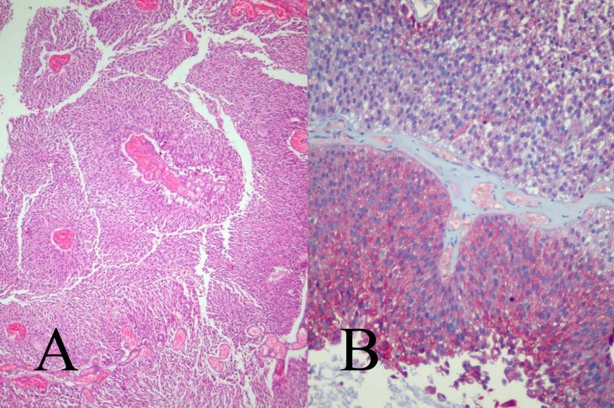 transitional cell carcinoma