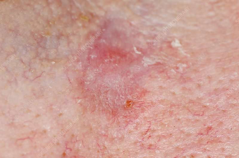 Treated skin cancer on cheek