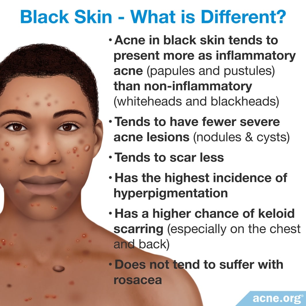 Treating Acne in Black Skin