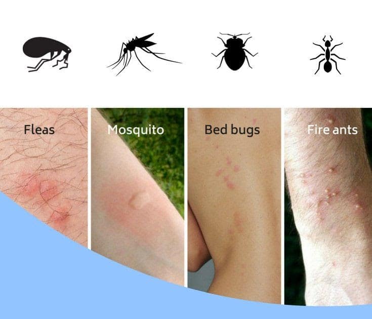 Treatment Bed Bug Bite Symptoms