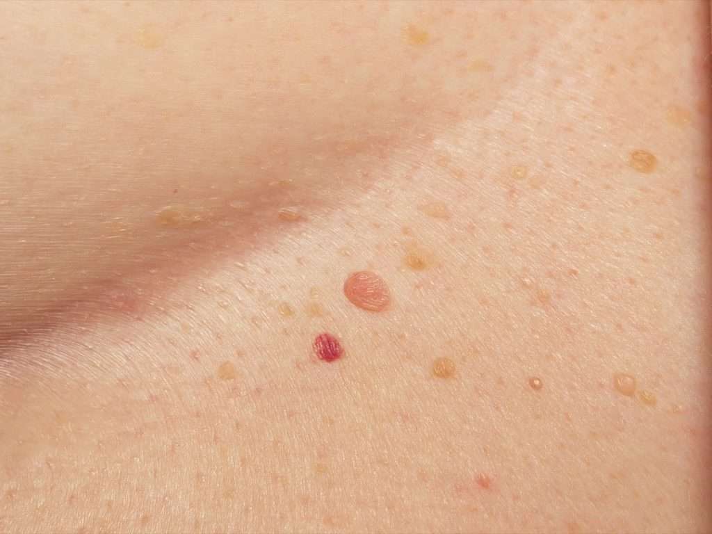 Treatments Warts and skin cancer