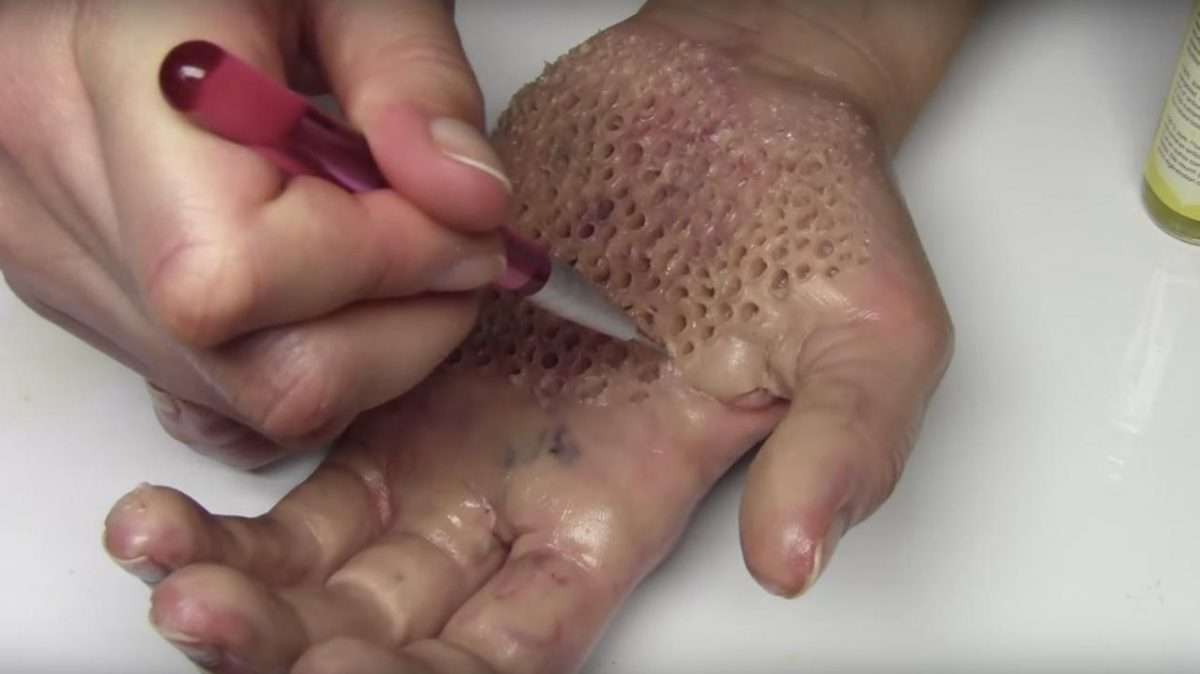 Trypophobia: What Is It? Test, Cause, Cure, Photos