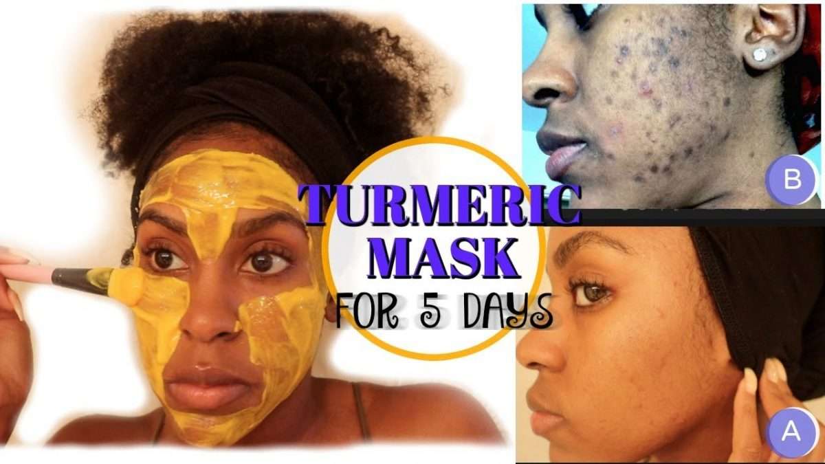 Turmeric Mask For Hyperpigmentation Before And After