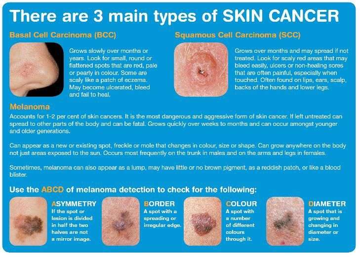 types of melanoma