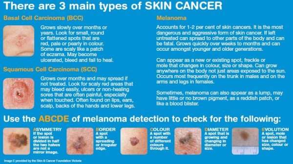 Types of Skin Cancer  Cancer Council ACT
