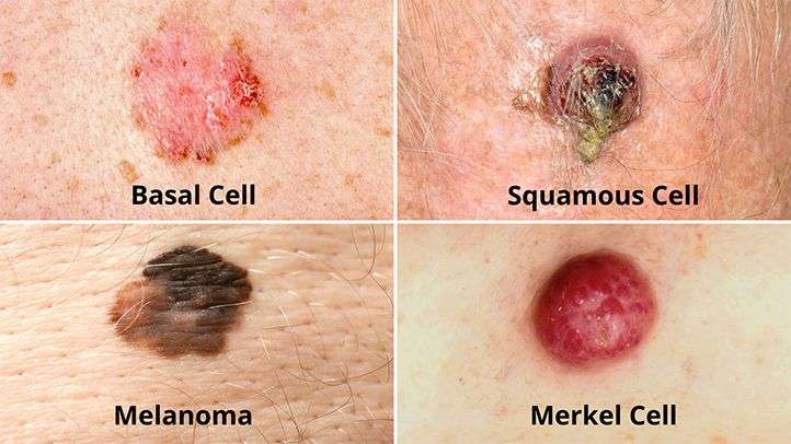 Types of Skin Cancer: Melanoma, Basal and Squamous Cell Carcinoma ...
