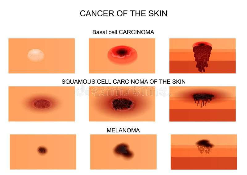 Types of skin cancer. stock vector. Illustration of lump ...