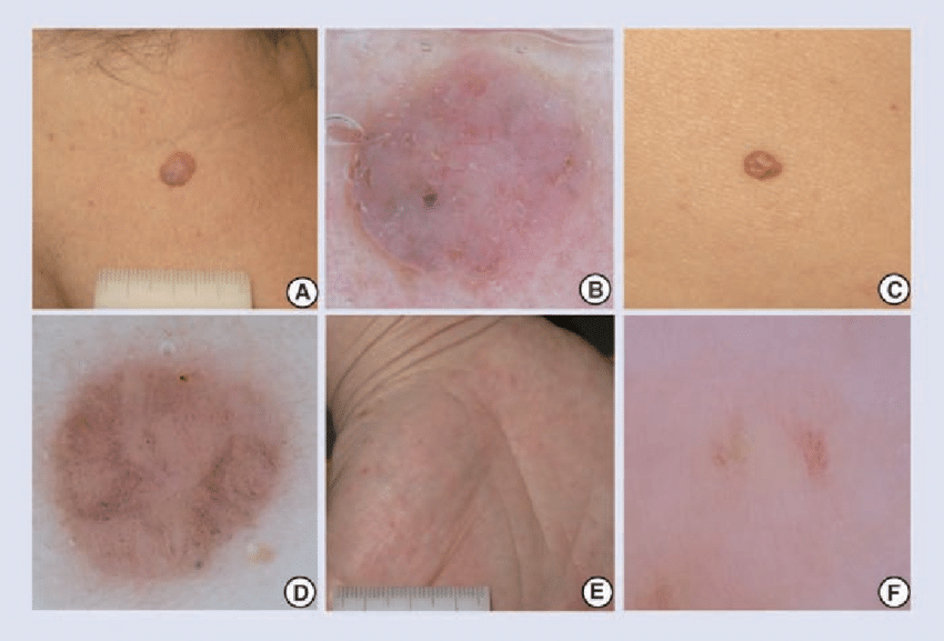 Uncommon subtypes of basal cell carcinoma. (A) Clinical ...