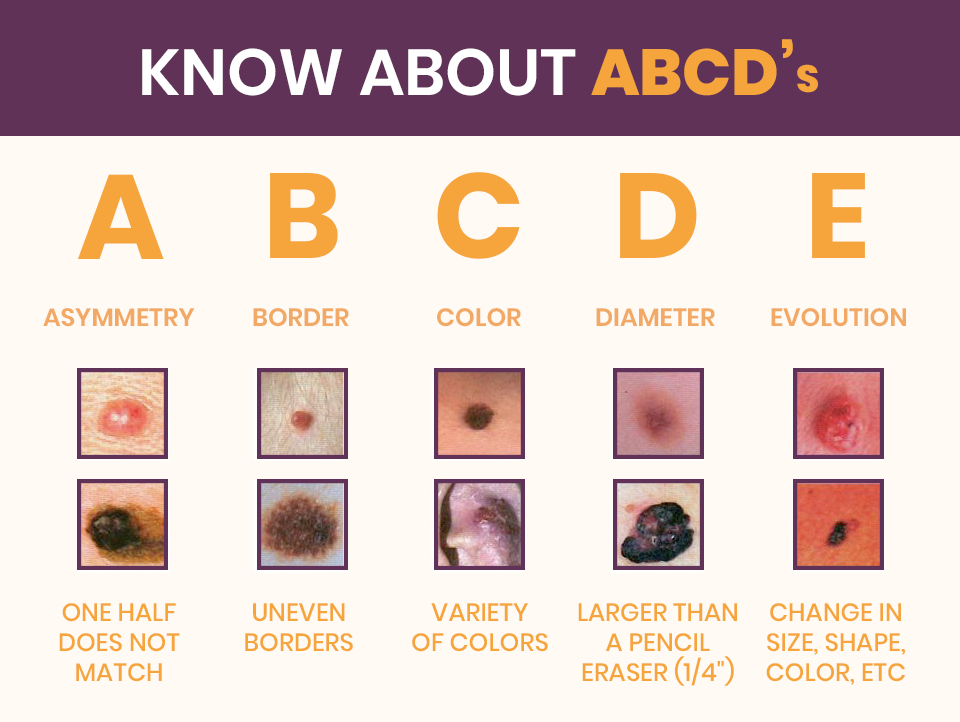 Understanding the Different Types of Skin Cancer ...