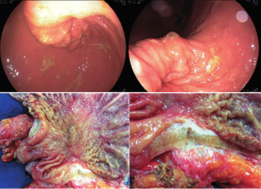 upper endoscopy showing breast cancer metastasis to the