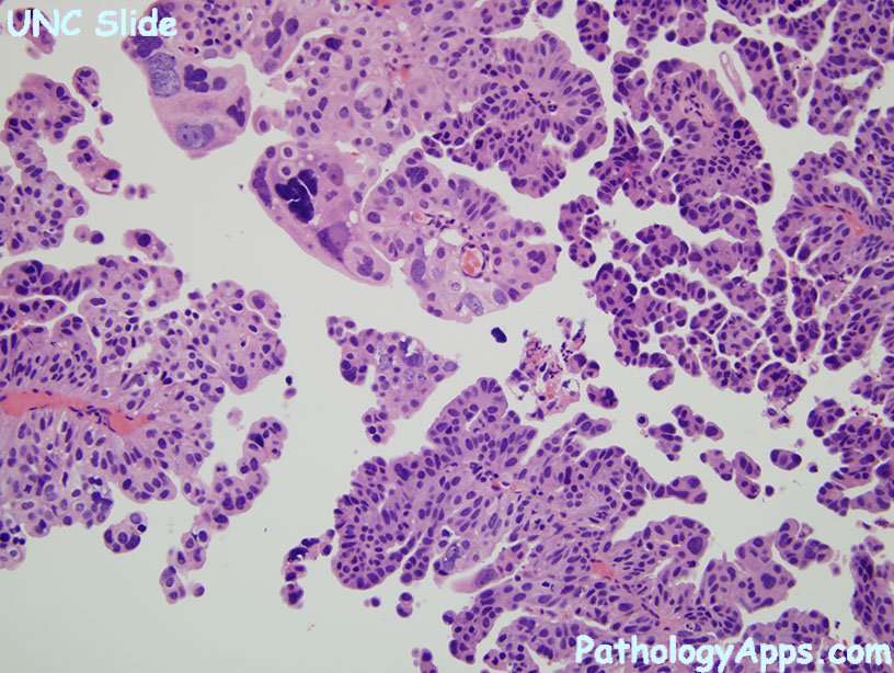 urothelial carcinoma pathology