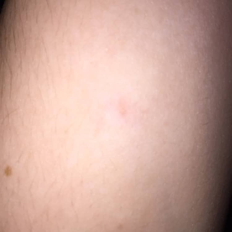 Very itchy!!! Little pin sized raised bumps all over body. Mostly on ...