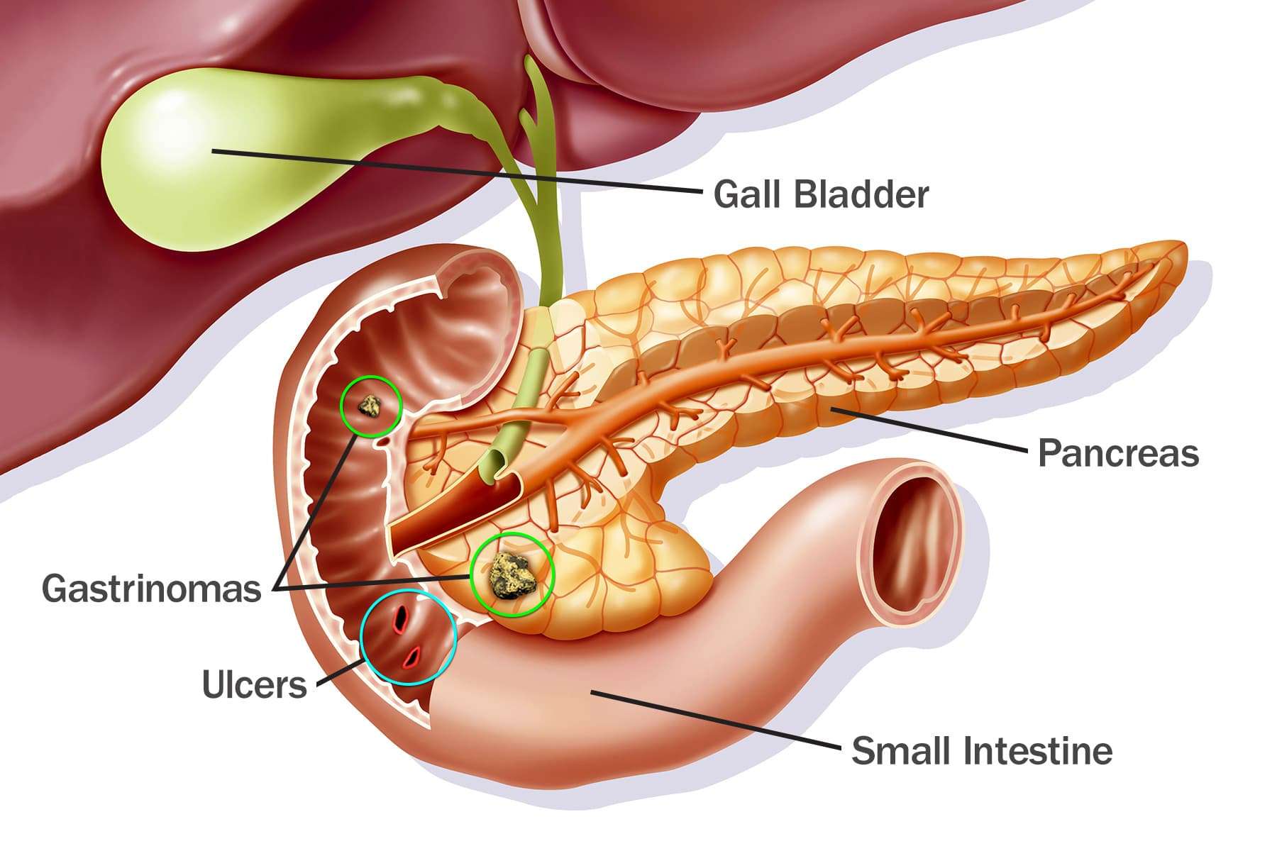 Visual Guide to Stomach Ulcers