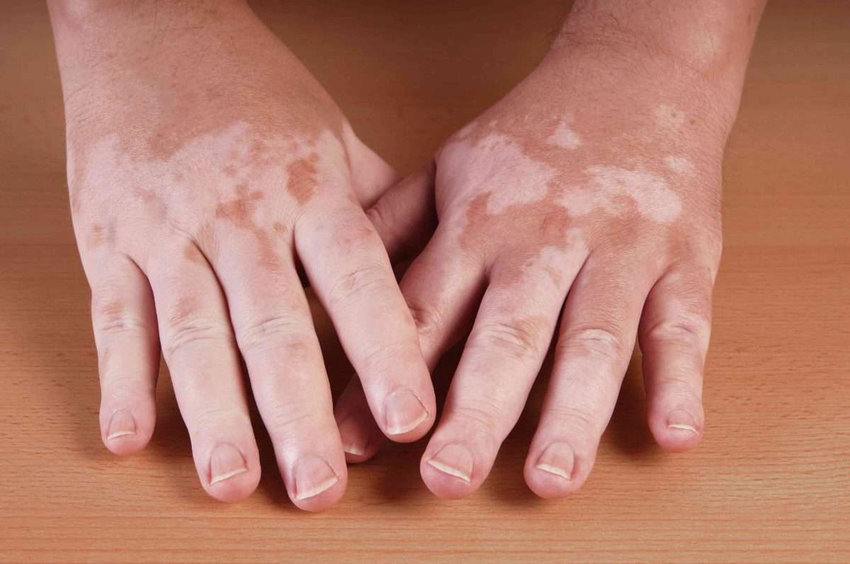 Vitiligo: Causes and Treatment of Skin Pigment Loss