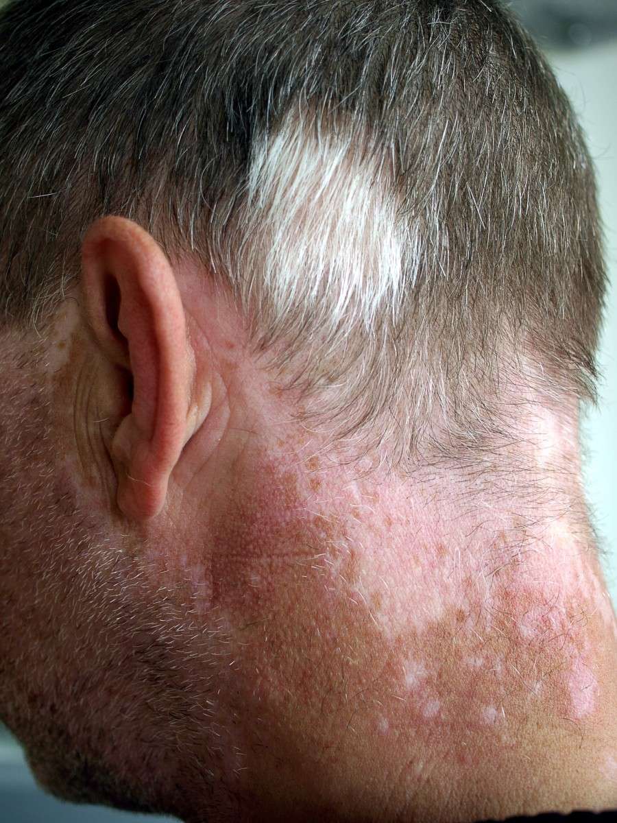 Vitiligo Facts: Skin Pigment Loss and Possible Treatments