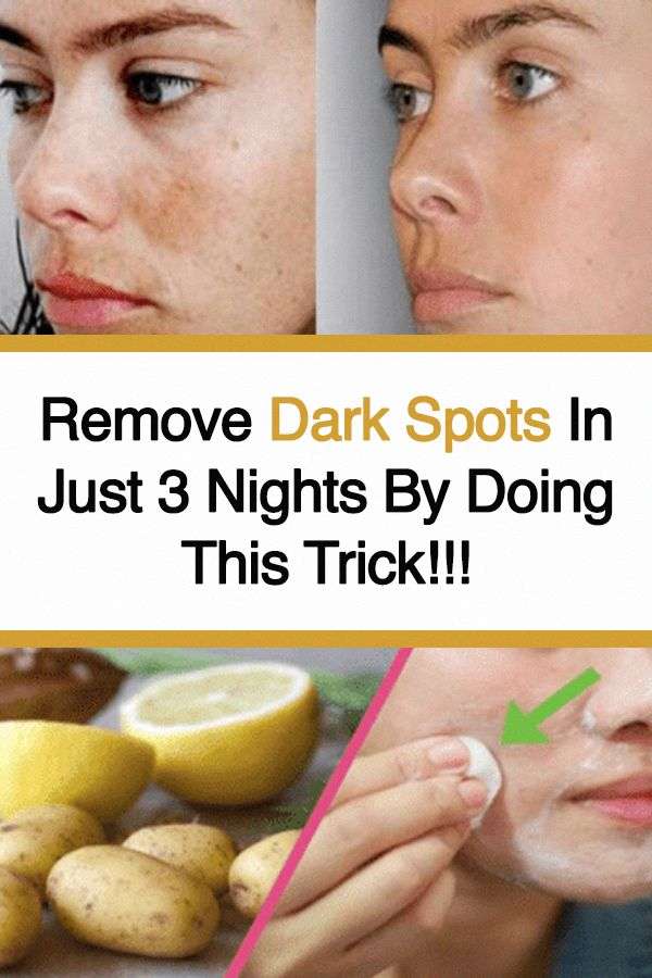 Ways to get Rid Of Darkish Spots on Deal with Overnight # ...