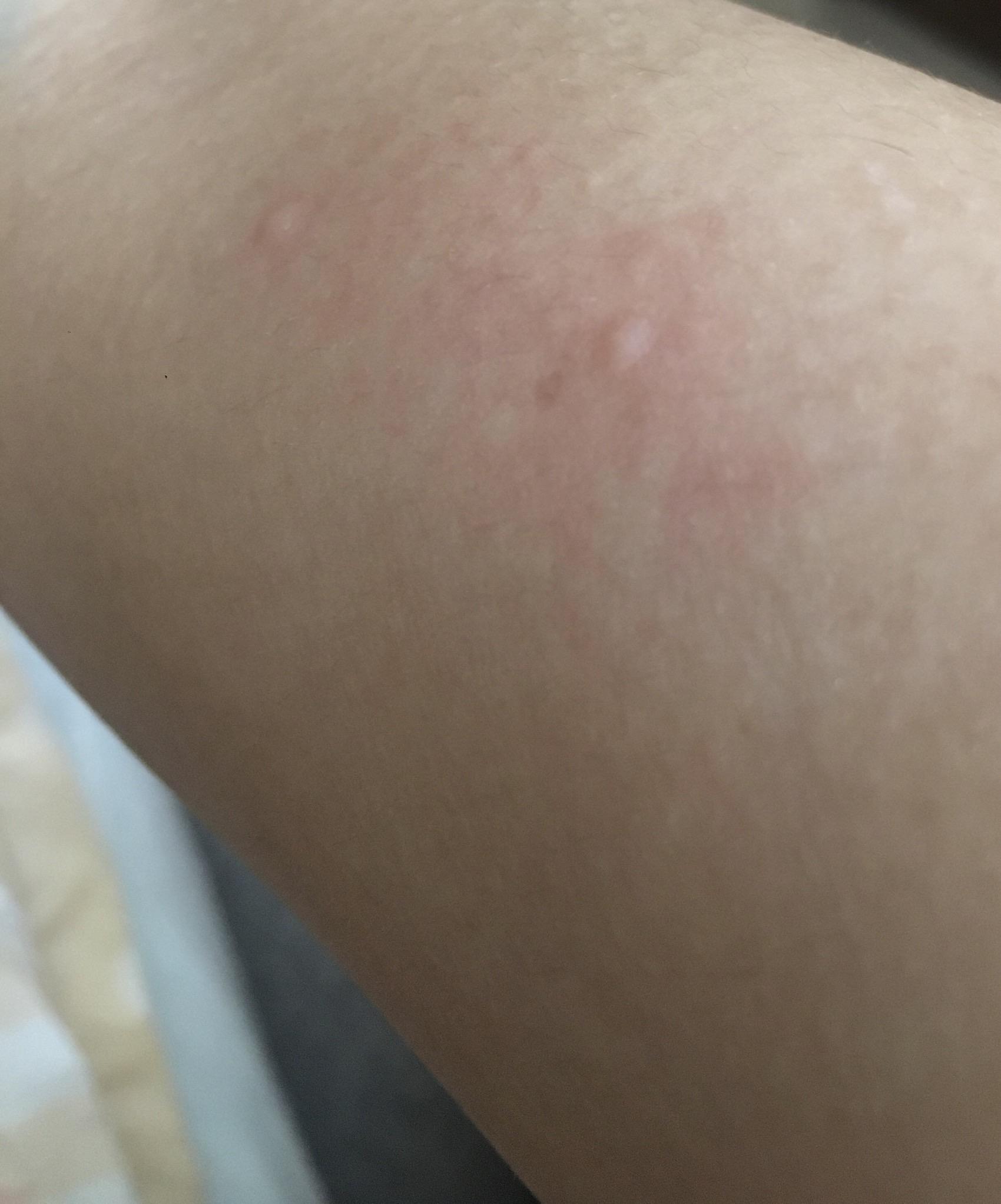 Weard side effect?! Small itchy red bumps that just suddenly appear ...