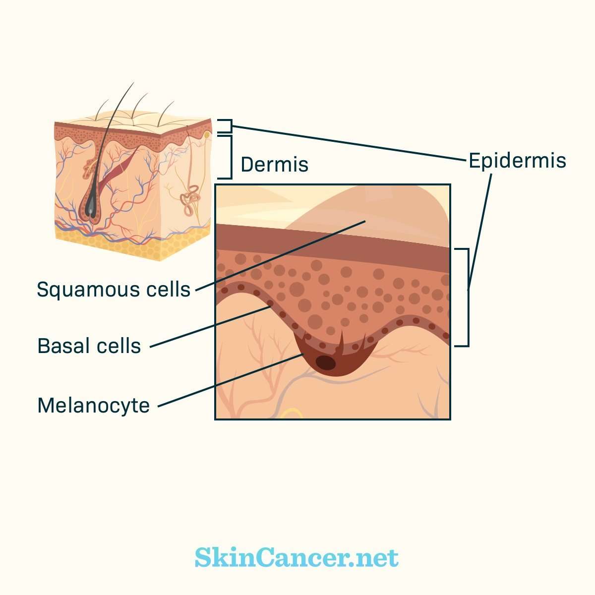 What Are the Causes of Skin Cancer?