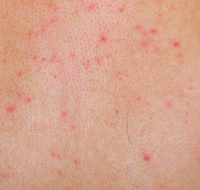 What Are the Different Types of Dry Skin Rashes?