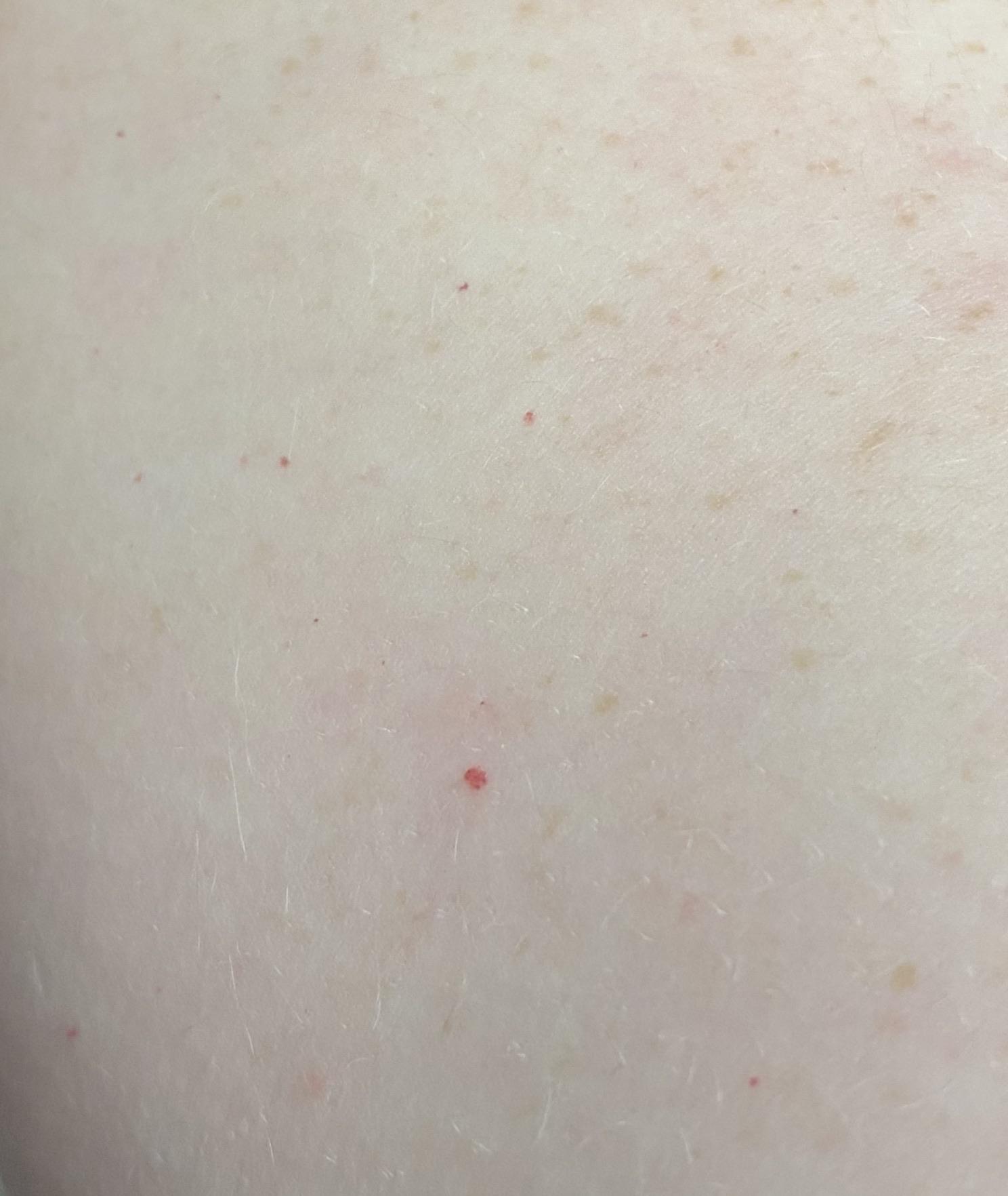 What are these little red dots on my arms? : Dermatology