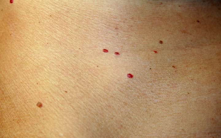 What Are Those Red Spots On Your Skin? How Can You Treat Them? â SkinKraft