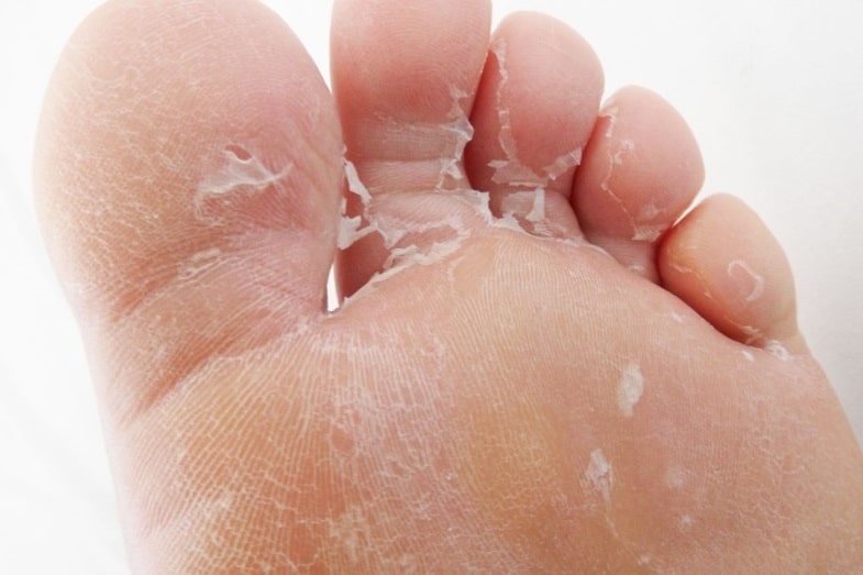 What causes skin peeling on bottom of feet? Real Facts
