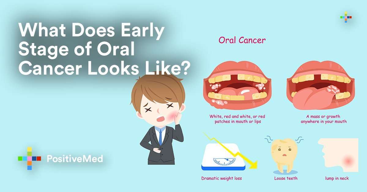 What Do Early Stages of Oral Cancer Look Like?