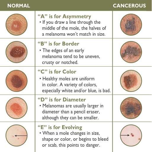 What do Skin Cancers Types Look Like? « CancerWORLD Cancer ...