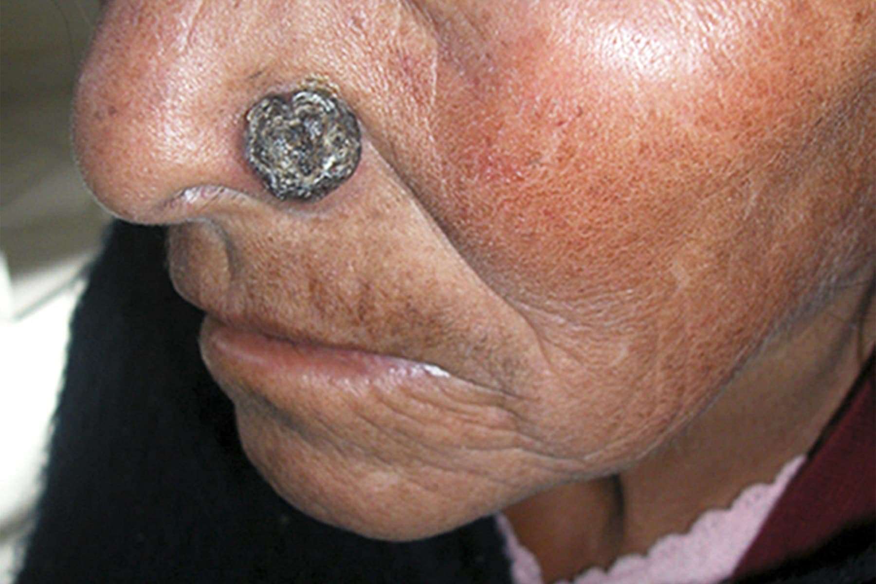 What Does Advanced Basal Cell Carcinoma Look Like?