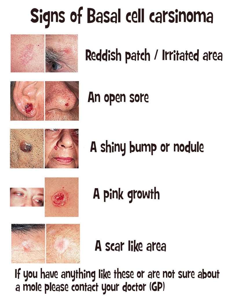 Basal Cell Skin Cancer Prognosis