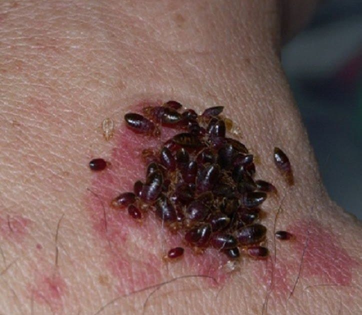 What Does Bed Bug Bites On Black People Skin?