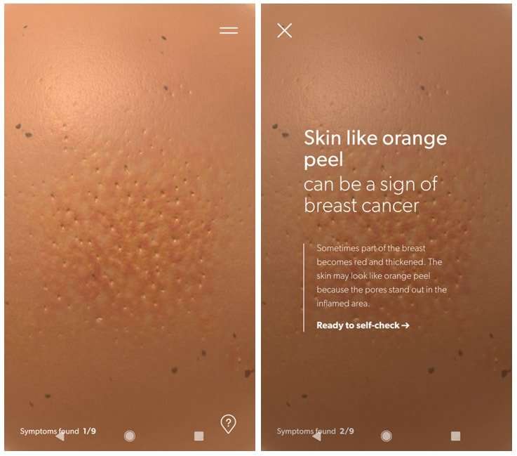 What Does Breast Cancer Orange Peel Skin Look Like ...