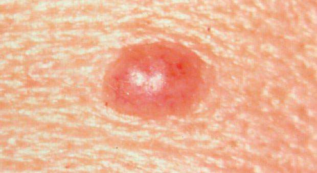 What Does Melanoma Look Like? 5 Skin Cancer Signs to Watch For