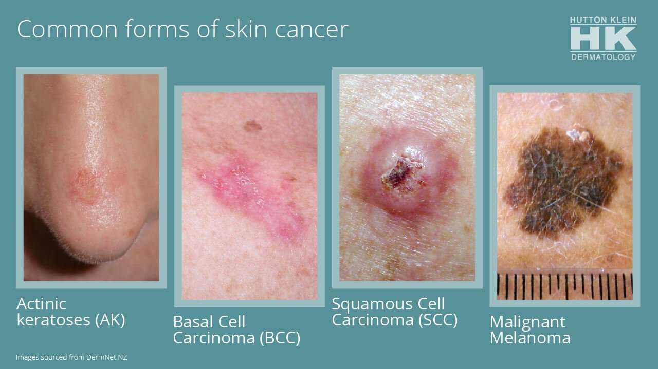 What Does Melanoma Look Like Pictures / Keeping Watch For ...