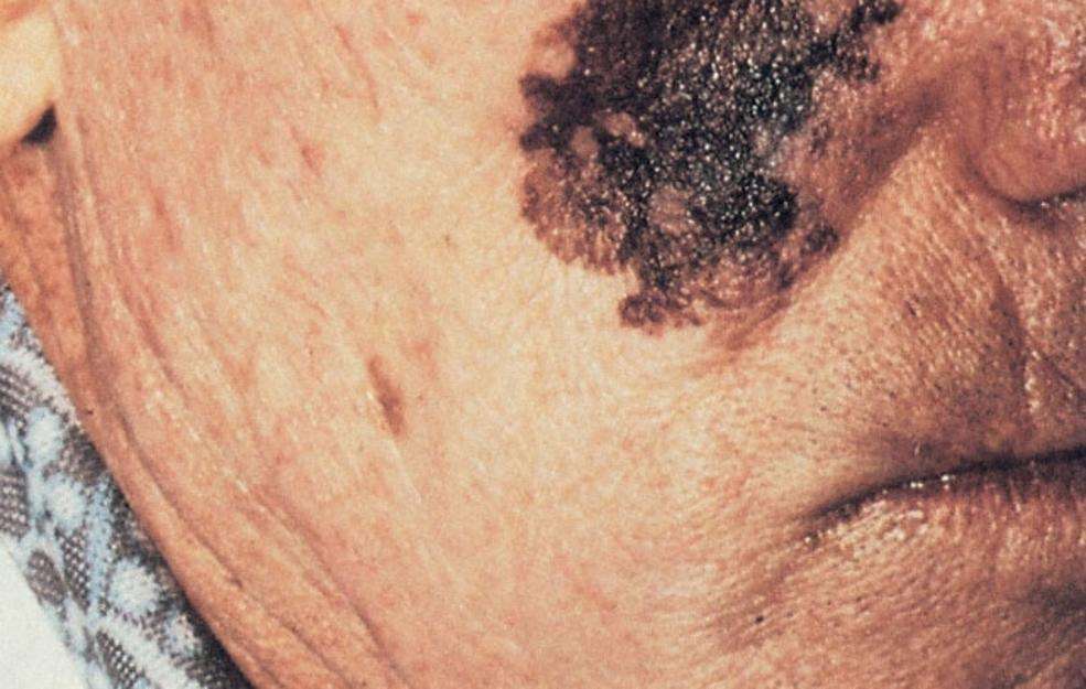 what-does-nodular-melanoma-look-like-healthyskinworld