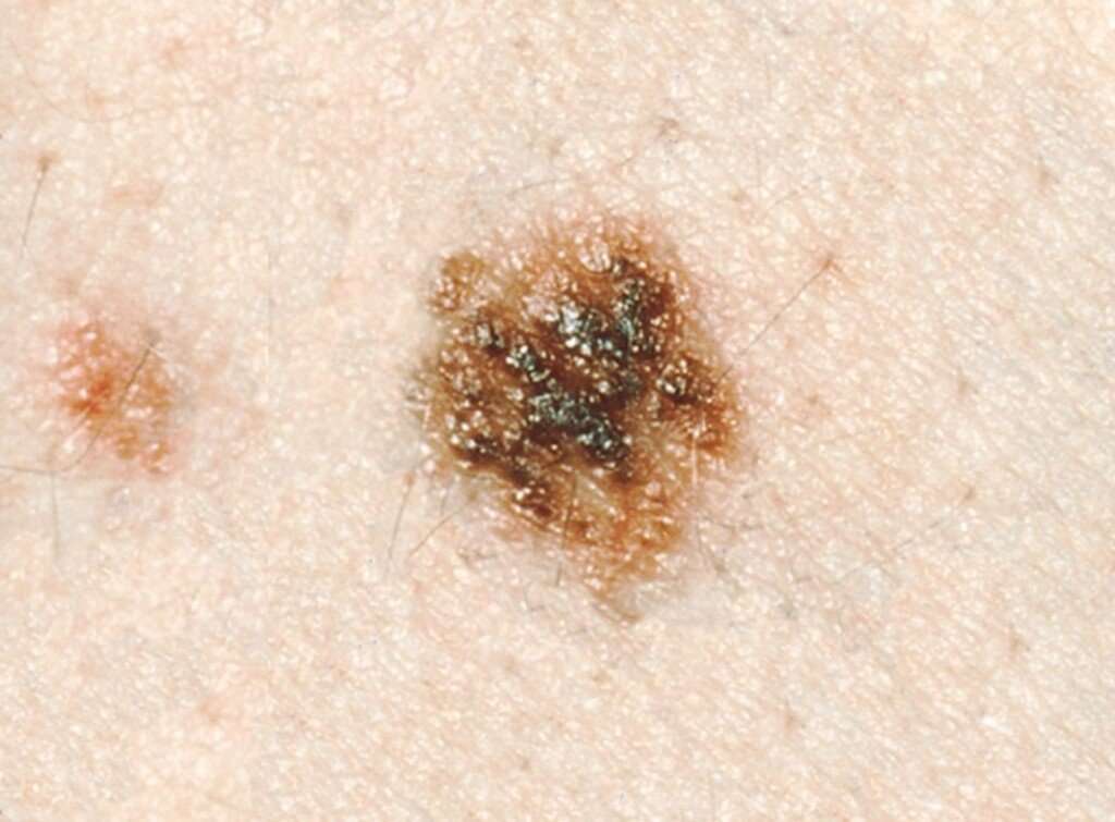 What Does Precancerous or Atypical Mole Mean? Â» Scary Symptoms