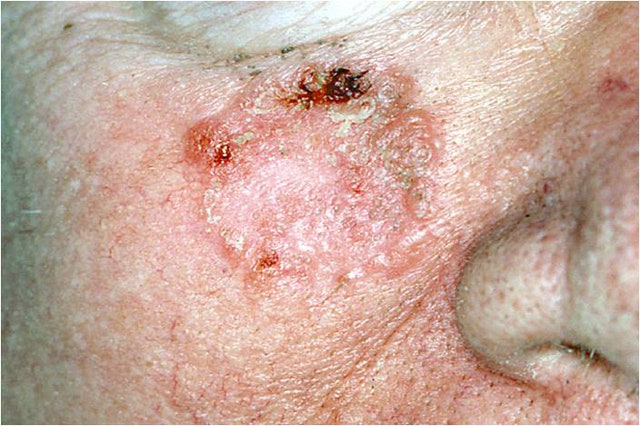 What Does Skin Cancer Look Like? A Visual Guide to Warning Signs