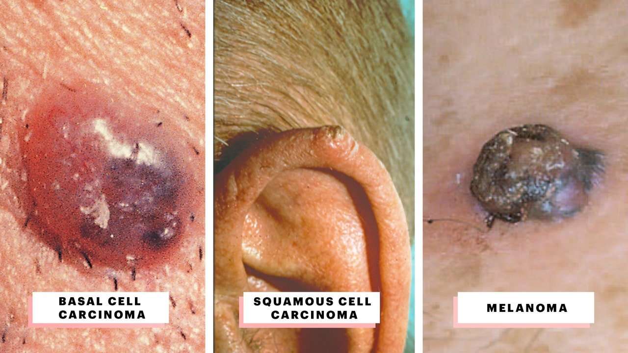What Does Skin Cancer Look Like? A Visual Guide to Warning Signs  SabKa Tv
