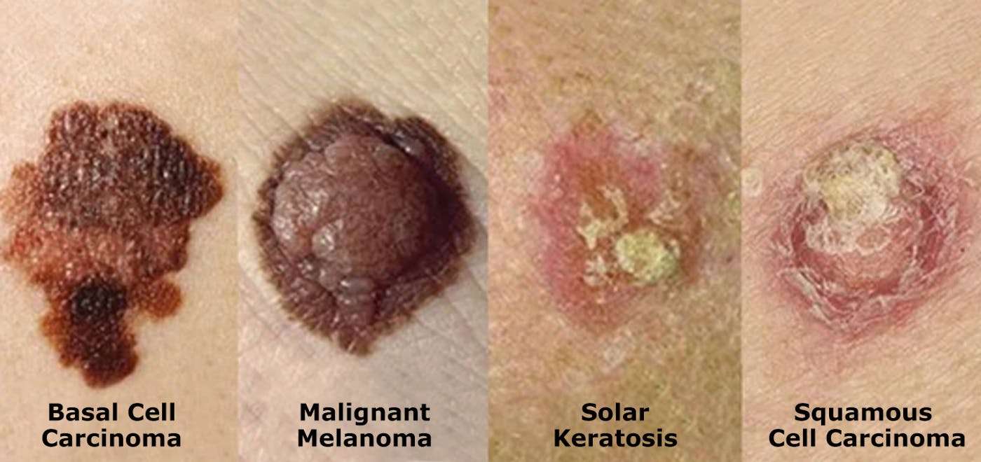 What Does Skin Cancer Look Like Anyway?