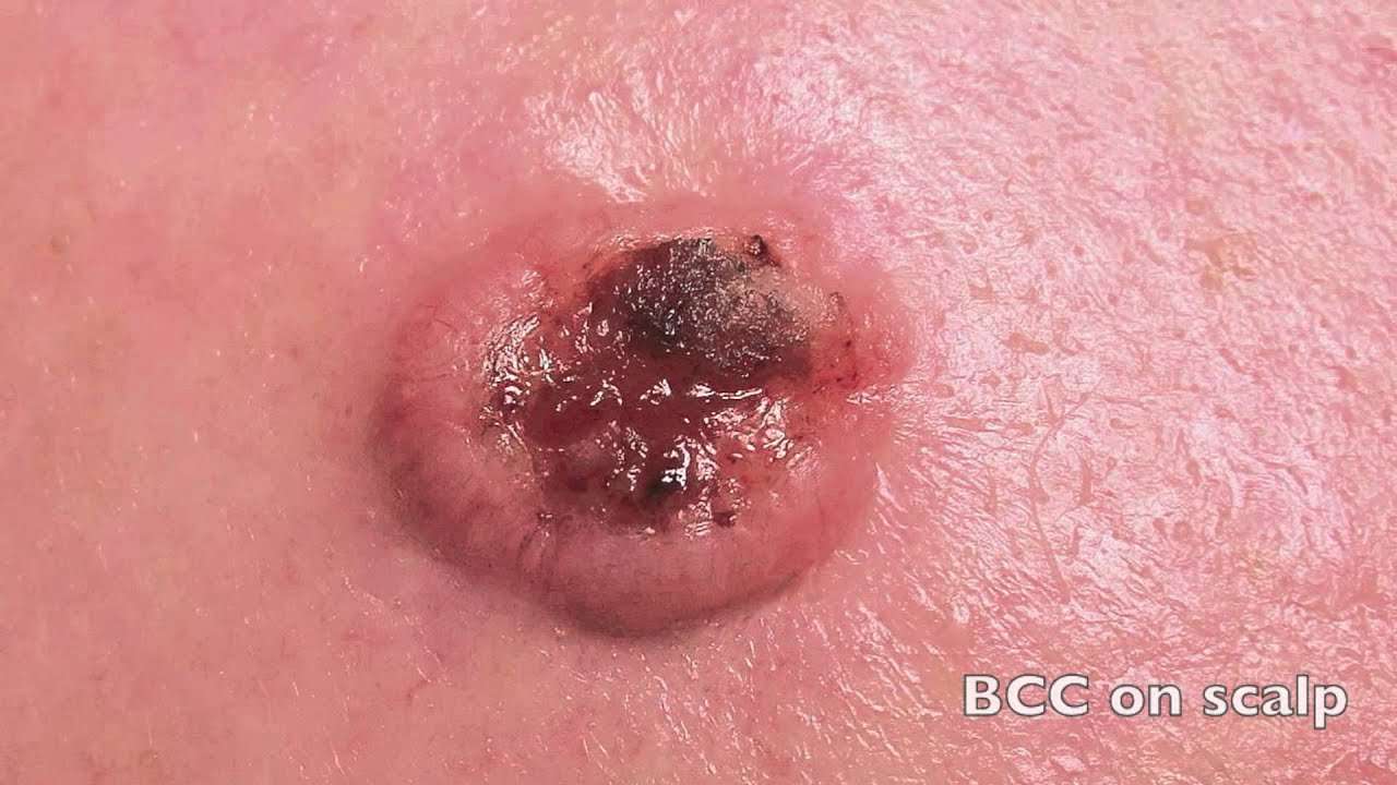What does skin cancer look like (basal cell carcinoma)