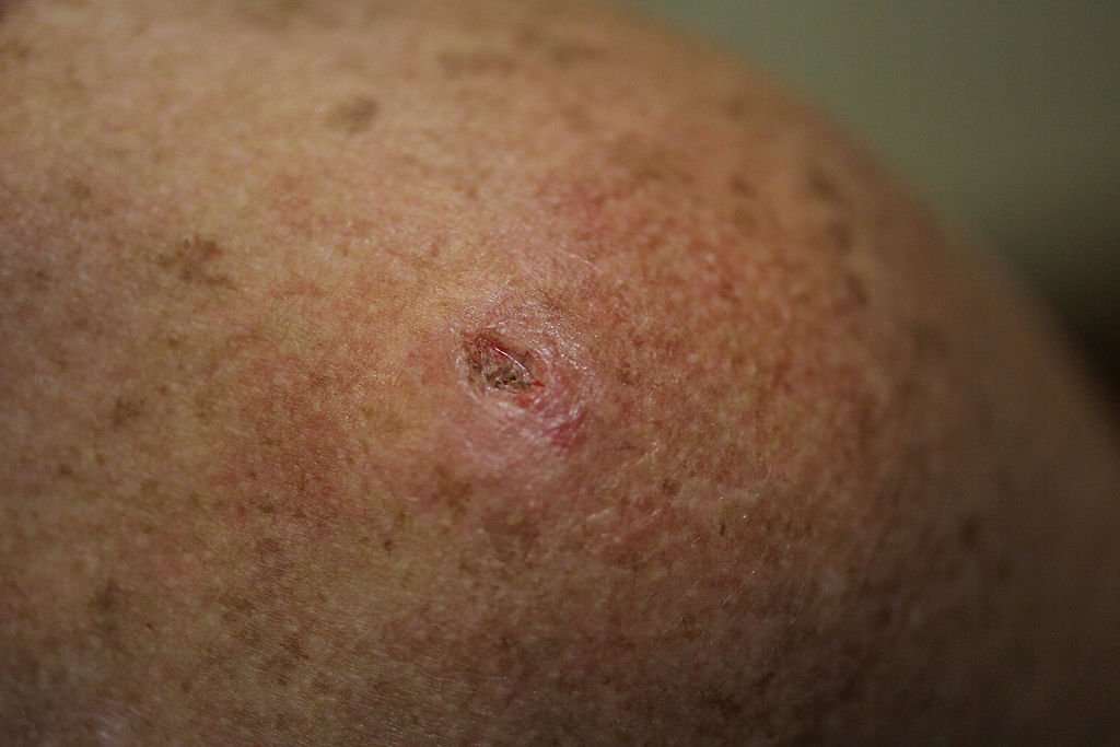 What Does Skin Cancer Look Like? : BEAUTY : Beauty World News