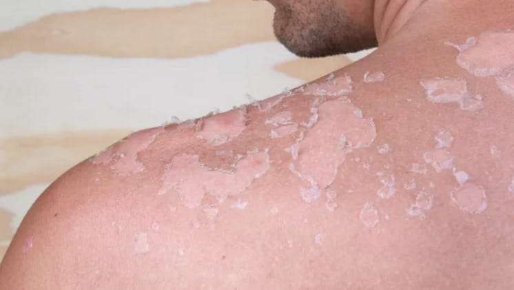 What Does Skin Cancer Look Like