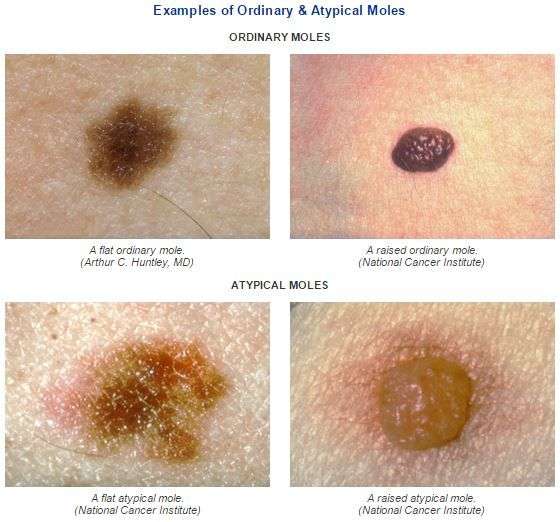 What Does Skin Cancer Look Like When It Starts
